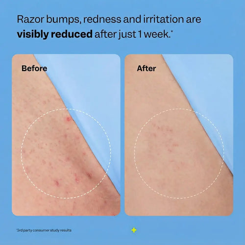 Smoothing Solution Ingrown Hair Treatment